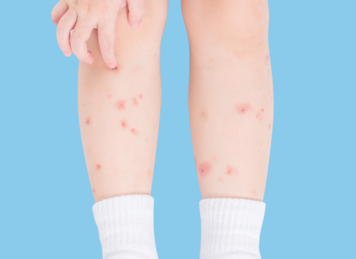 Picaduras de mosquito